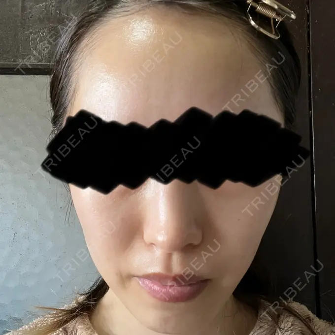 脂肪溶解注射（顔） SK新宿歌舞伎町美容外科・歯科 AFTER メイン用