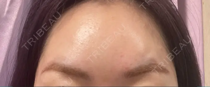 ボトックス（眉間） TCB東京中央美容外科 心斎橋院 AFTER メイン用