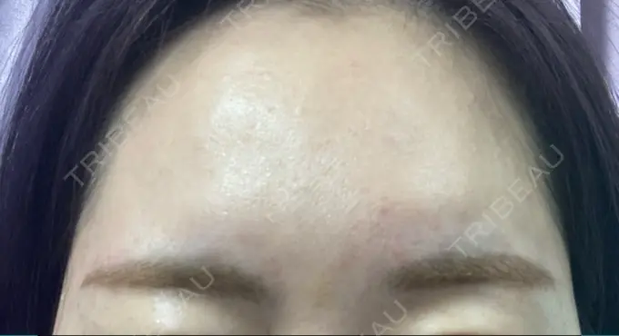 ボトックス（眉間） TCB東京中央美容外科 心斎橋院 DAY 7 メイン用