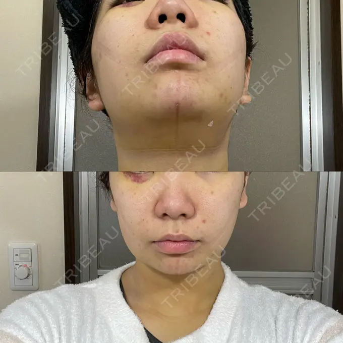 脂肪吸引（顔） / 下まぶたたるみ取り / メーラーファット除去 WOM CLINIC GINZA （ワム クリニック ギンザ） DAY 6 メイン用