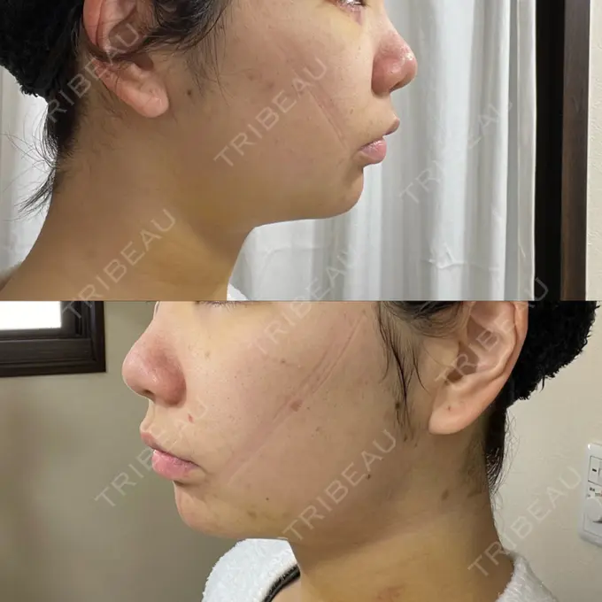 脂肪吸引（顔） / 下まぶたたるみ取り / メーラーファット除去 WOM CLINIC GINZA （ワム クリニック ギンザ） DAY 6 メイン用