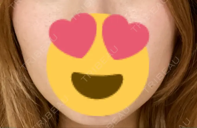 ボトックス（エラ・小顔） TCB東京中央美容外科 名古屋栄院 DAY 13 メイン用