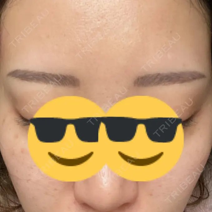 アートメイク（眉） アモーレクリニック 名古屋院 AFTER メイン用