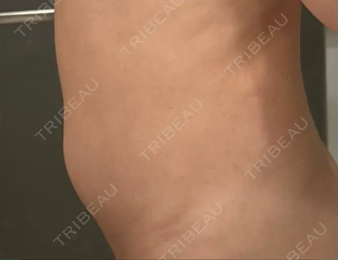 医療痩身（お腹） / 脂肪冷却（お腹） 吉祥寺アイビークリニック DAY 5 メイン用