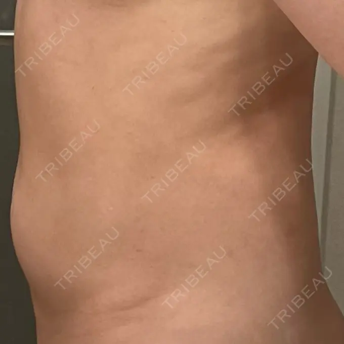 医療痩身（お腹） / 脂肪冷却（お腹） 吉祥寺アイビークリニック DAY 4 メイン用