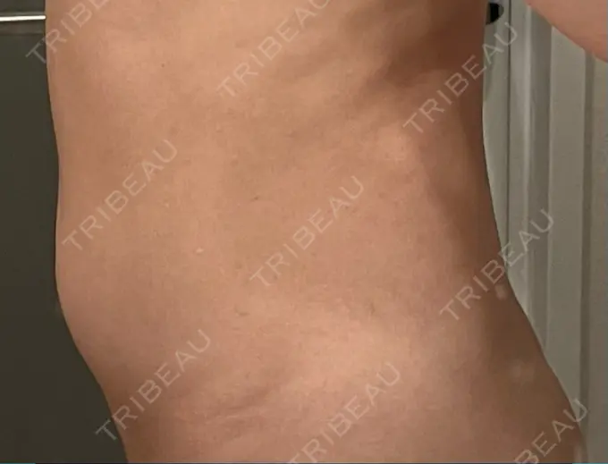 医療痩身（お腹） / 脂肪冷却（お腹） 吉祥寺アイビークリニック DAY 3 メイン用