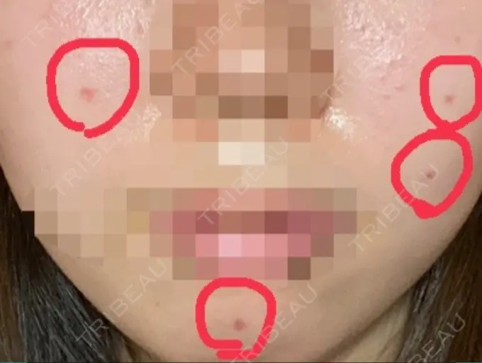 ほくろ・いぼ切除（肌） LIKI CLINIC KOBE DAY 21 メイン用