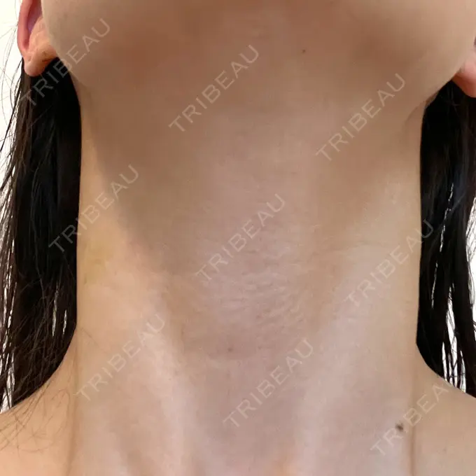 ヒアルロン酸注入（首） / PRP皮膚再生療法 ももスキンケアクリニック DAY 7 メイン用