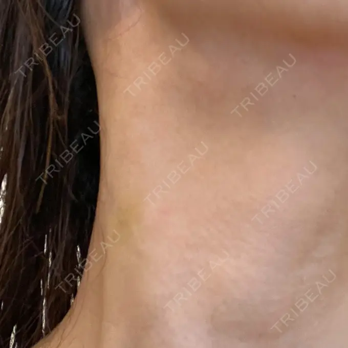 ヒアルロン酸注入（首） / PRP皮膚再生療法 ももスキンケアクリニック DAY 7 メイン用