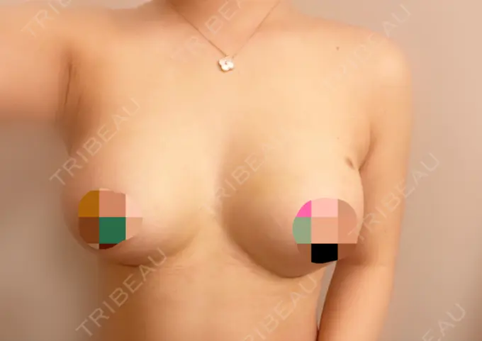 豊胸（シリコンバッグ） MYCLI【マイクリ】東京・恵比寿院 DAY 11 メイン用