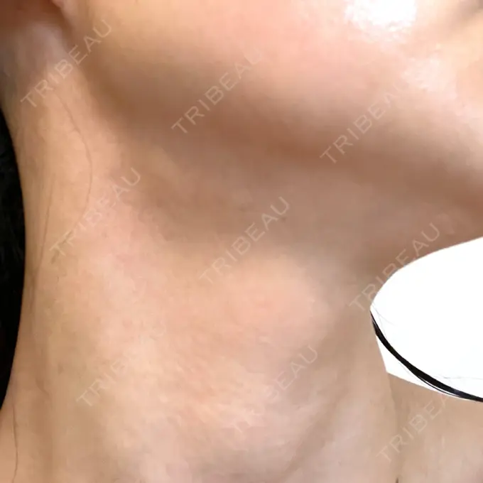 ヒアルロン酸注入（首） / PRP皮膚再生療法 ももスキンケアクリニック DAY 8 メイン用