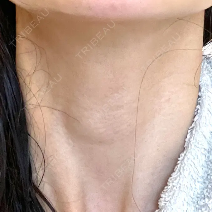 ヒアルロン酸注入（首） / PRP皮膚再生療法 ももスキンケアクリニック AFTER メイン用