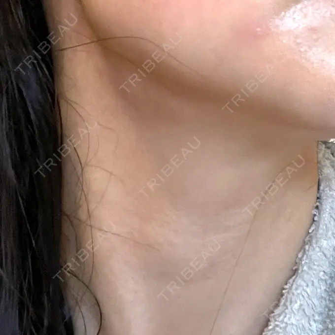 ヒアルロン酸注入（首） / PRP皮膚再生療法 ももスキンケアクリニック DAY 13 メイン用
