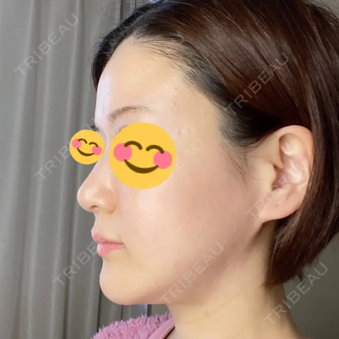 骨切り（あご） / 骨削り（エラ） / セットバック / その他（輪郭） アーククリニック DAY 346 メイン用