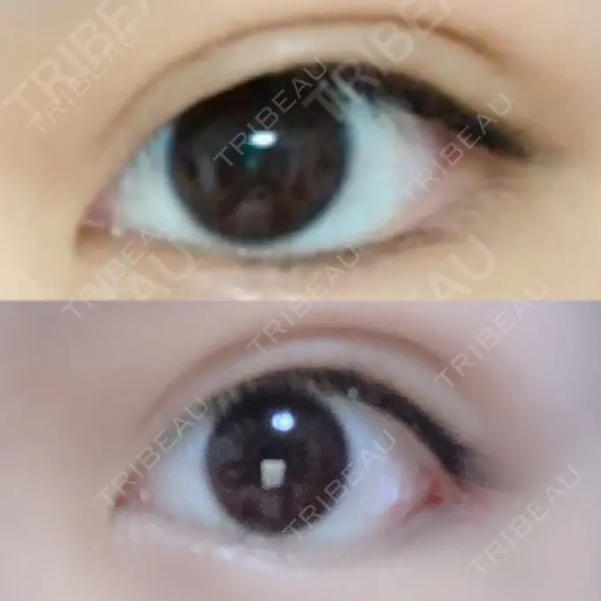 目尻切開 / タレ目形成・グラマラスライン（切開） / 目尻靭帯移動 FROM B整形外科 (旧バウム整形外科) DAY 32 メイン用