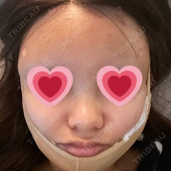 糸リフト / 脂肪吸引（顔） / 脂肪注入（額） X CLINIC 恵比寿院 DAY 1 メイン用