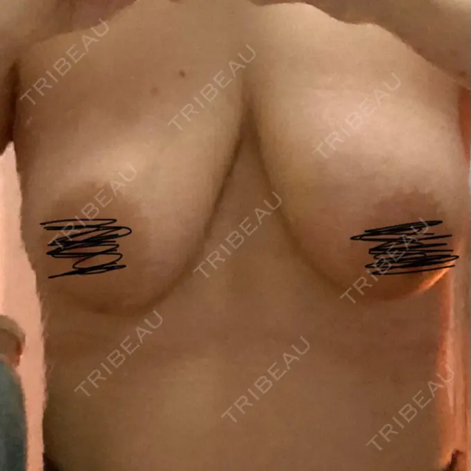 胸修正 / その他（胸） 湘南美容クリニック 神戸三宮院 DAY 3 メイン用