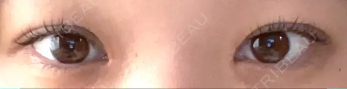 二重埋没 / 目頭切開 くさのたろうクリニック DAY 68 メイン用