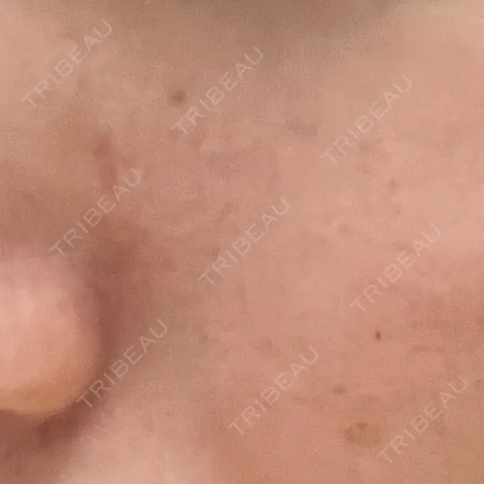 イオン導入 / 毛穴洗浄（ハイドラフェイシャルなど） / ポテンツァ A CLINIC（エークリニック） 横浜院 DAY 3 メイン用