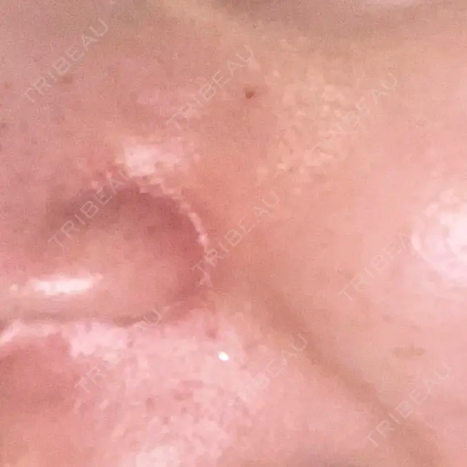 イオン導入 / 毛穴洗浄（ハイドラフェイシャルなど） / ポテンツァ A CLINIC（エークリニック） 横浜院 DAY 5 メイン用