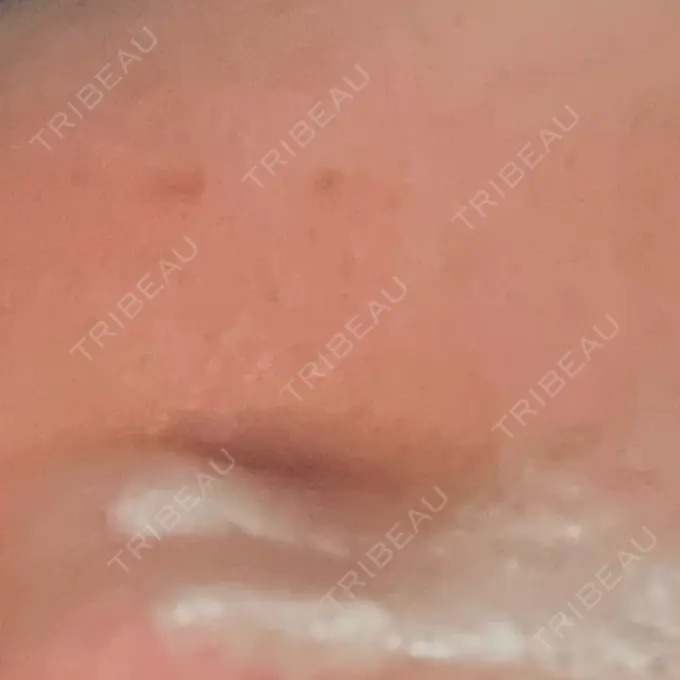 イオン導入 / 毛穴洗浄（ハイドラフェイシャルなど） / ポテンツァ A CLINIC（エークリニック） 横浜院 DAY 6 メイン用