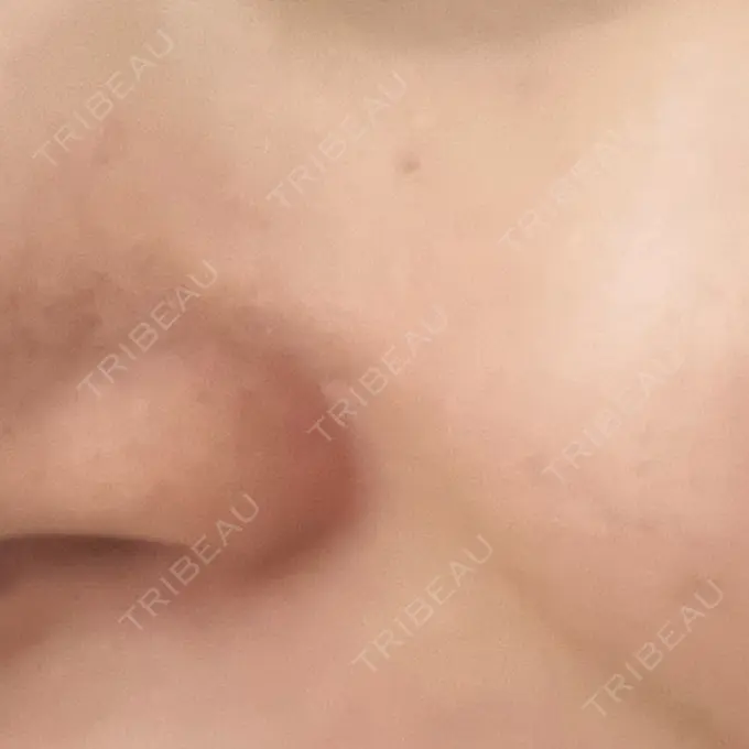 イオン導入 / 毛穴洗浄（ハイドラフェイシャルなど） / ポテンツァ A CLINIC（エークリニック） 横浜院 AFTER メイン用