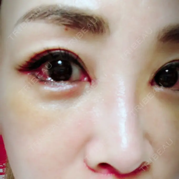 目頭切開 / 目尻切開 / 下まぶたの脂肪取り / タレ目形成・グラマラスライン（切開） / その他（目元） BIANCA銀座 DAY 7 メイン用