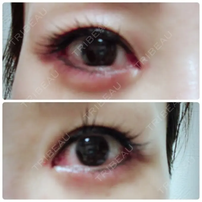 目頭切開 / 目尻切開 / 下まぶたの脂肪取り / タレ目形成・グラマラスライン（切開） / その他（目元） BIANCA銀座 DAY 16 メイン用