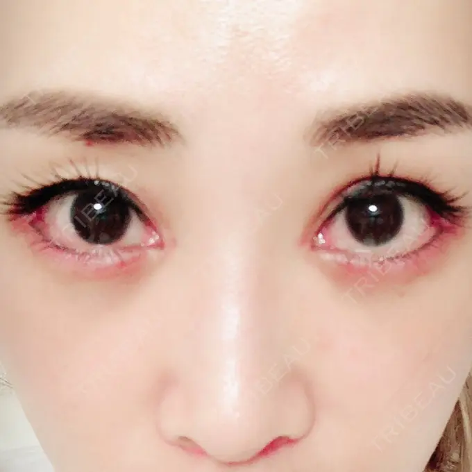 目頭切開 / 目尻切開 / 下まぶたの脂肪取り / タレ目形成・グラマラスライン（切開） / その他（目元） BIANCA銀座 DAY 16 メイン用