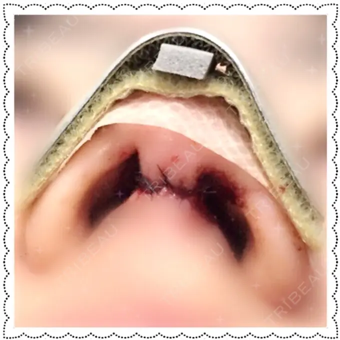 小鼻縮小（切開） Dual Clinic KOBE DAY 1 メイン用