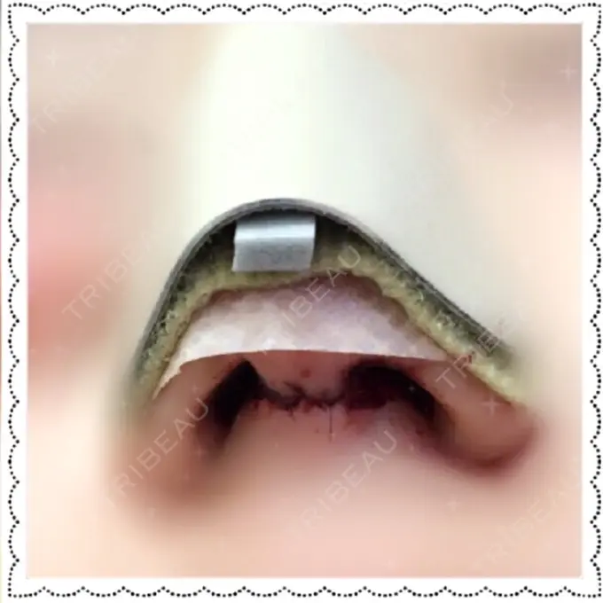 小鼻縮小（切開） Dual Clinic KOBE DAY 1 メイン用