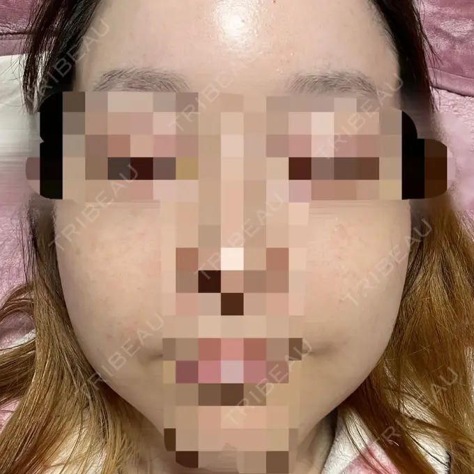 ヴェルヴェットスキン アリエル美容クリニック 大宮院 AFTER メイン用