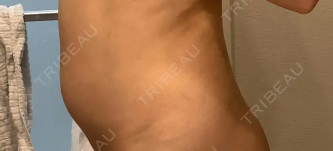 医療痩身（お腹） / 脂肪冷却（お腹） 吉祥寺アイビークリニック DAY 11 メイン用