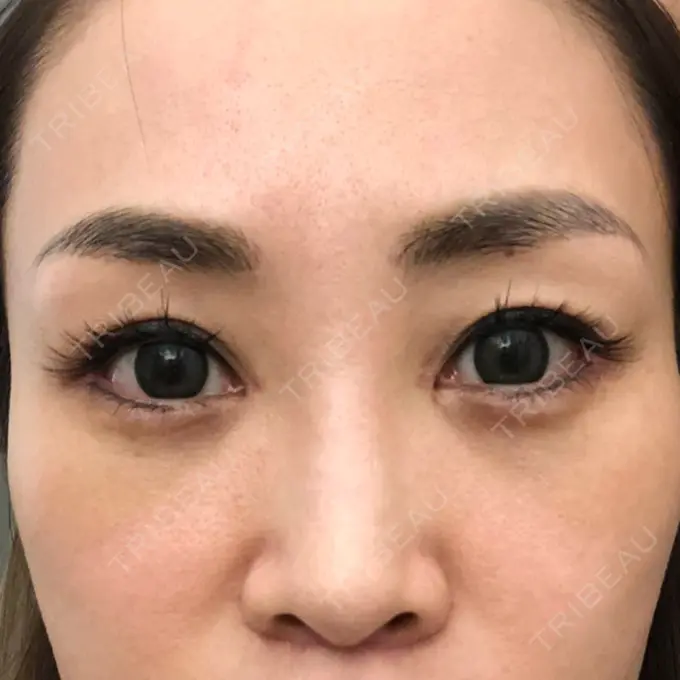 目頭切開 / 目尻切開 / 下まぶたの脂肪取り / タレ目形成・グラマラスライン（切開） / その他（目元） BIANCA銀座 DAY 32 メイン用