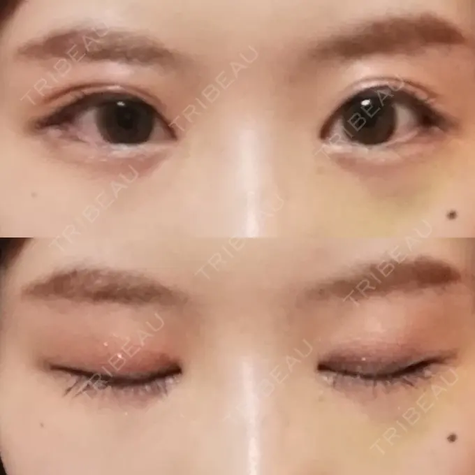 目頭切開 / 目尻切開 / 水光注射（ハリ・美肌） エートップ美容整形外科 DAY 10 メイン用