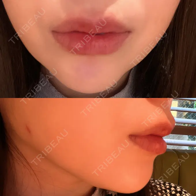 ボトックス（人中） Taide Suenaga Clinic（タイデスエナガクリニック） DAY 0 メイン用