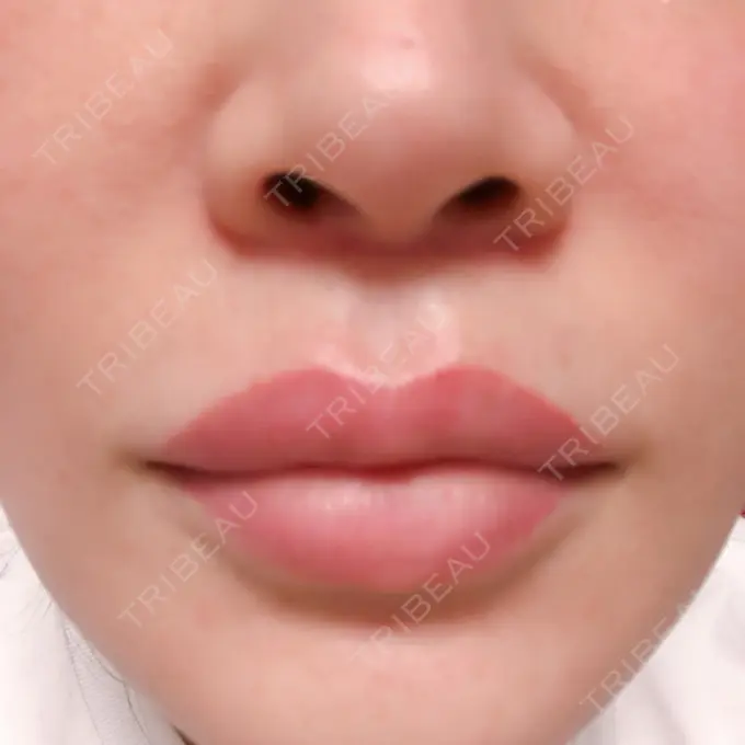 目頭切開 / 目尻切開 / 下まぶたの脂肪取り / タレ目形成・グラマラスライン（切開） / その他（目元） BIANCA銀座 DAY 50 メイン用