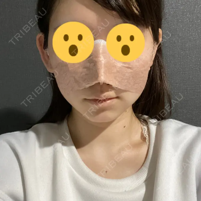 鼻尖形成（切開） / 小鼻縮小（切開） / 軟骨移植 / 鼻孔縁挙上 東京美容医療クリニック 池袋院 DAY 1 メイン用