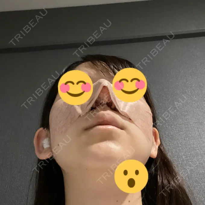 鼻尖形成（切開） / 小鼻縮小（切開） / 軟骨移植 / 鼻孔縁挙上 東京美容医療クリニック 池袋院 DAY 1 メイン用