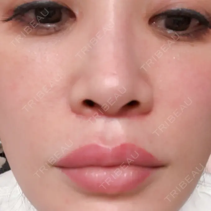 目頭切開 / 目尻切開 / 下まぶたの脂肪取り / タレ目形成・グラマラスライン（切開） / その他（目元） BIANCA銀座 DAY 50 メイン用