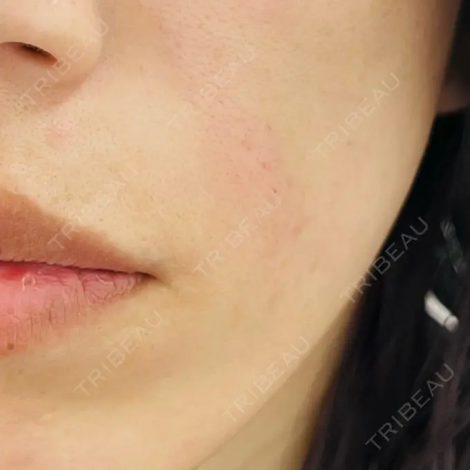 肌ヒアルロン酸注入（たるみ・シワ改善） TCB東京中央美容外科 郡山院 AFTER メイン用