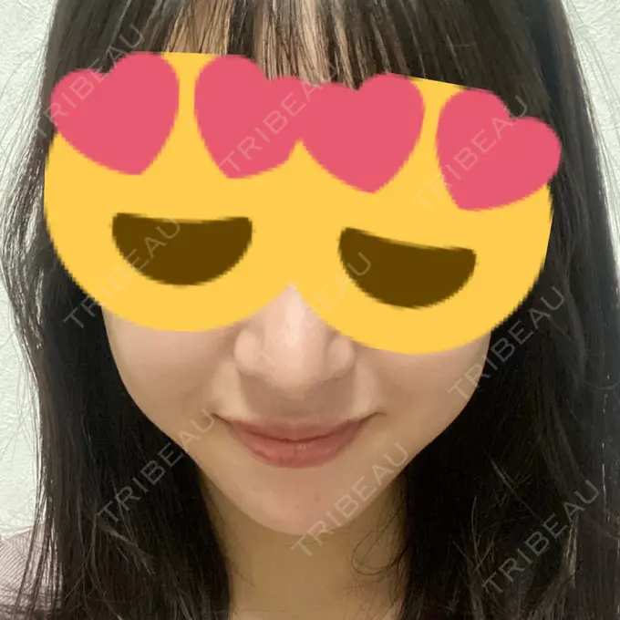 ヒアルロン酸注入（唇） / ボトックス（口角） オーマイクリニック【Oh My Clinic】 AFTER メイン用