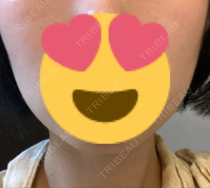 ボトックス（エラ・小顔） TCB東京中央美容外科 名古屋栄院 DAY 25 メイン用