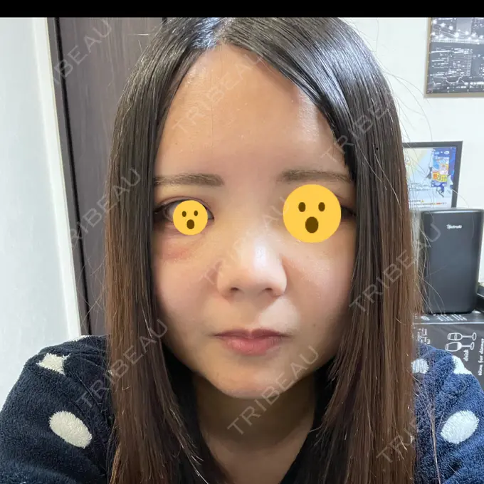 糸リフト / 脂肪吸引（顔） / 脂肪注入（額） X CLINIC 恵比寿院 DAY 5 メイン用