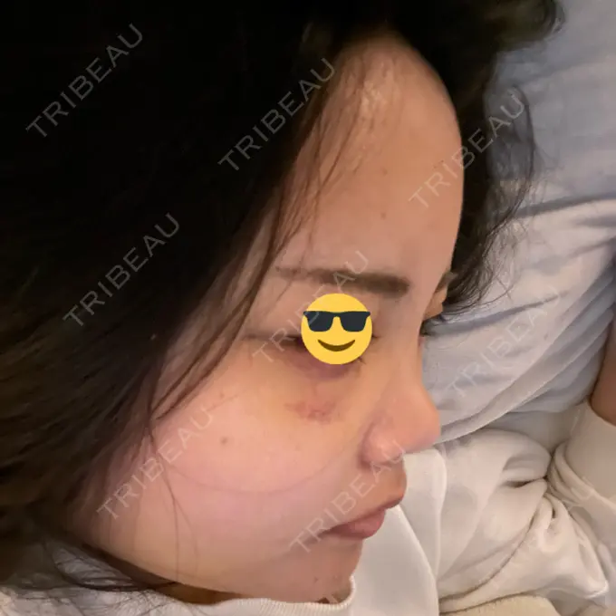 糸リフト / 脂肪吸引（顔） / 脂肪注入（額） X CLINIC 恵比寿院 DAY 6 メイン用