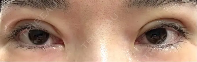 二重切開 / 眼瞼下垂（切開） / 目元修正 城本クリニック 姫路院 DAY 9 メイン用