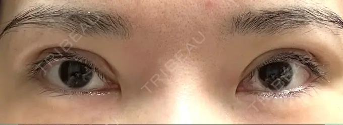 二重切開 / 眼瞼下垂（切開） / 目元修正 城本クリニック 姫路院 DAY 24 メイン用