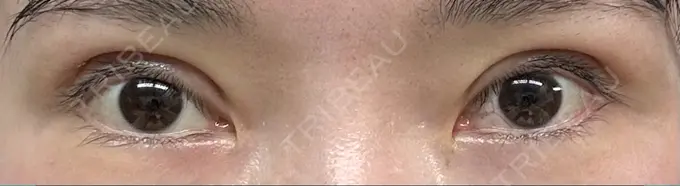 二重切開 / 眼瞼下垂（切開） / 目元修正 城本クリニック 姫路院 DAY 37 メイン用