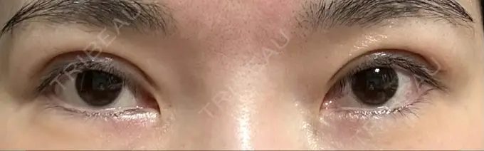 二重切開 / 眼瞼下垂（切開） / 目元修正 城本クリニック 姫路院 DAY 46 メイン用