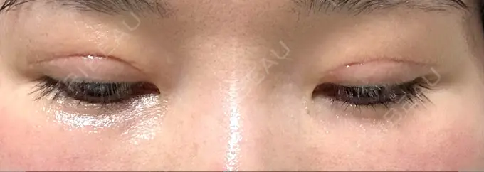 二重切開 / 眼瞼下垂（切開） / 目元修正 城本クリニック 姫路院 DAY 66 メイン用